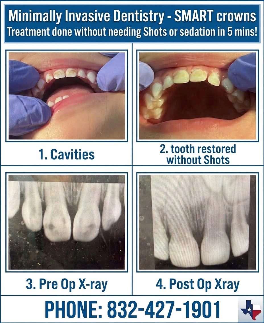Smart crown before and after
